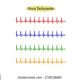 ECG Of Sinus Tachycardia, Sinus Tach Or Sinus Tachy Is Heart Rate Faster Than Normal (more Than 100 Bpm.)