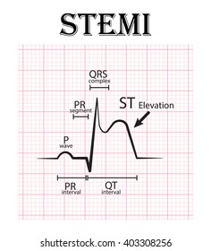 ECG of ST elevation myocardial infarction ( STEMI ) and detail of ECG ( P wave , PR segment , PR interval , QRS complex , QT interval , ST elevate , T wave )  Acute coronary syndrome , angina pectoris