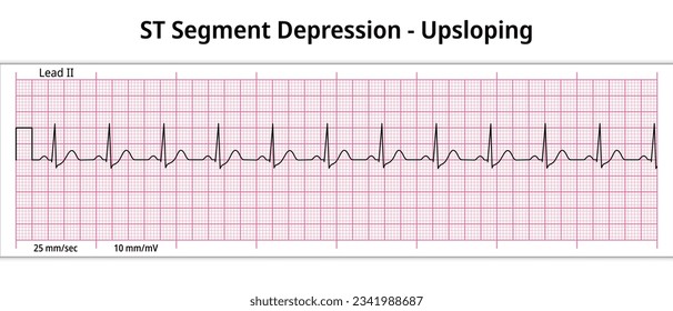 ECG ST Segment Depression - 8 Second ECG Paper - Electrocardiogram Vector Medical Illustration