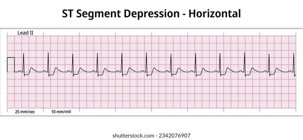 ECG ST Segment Depression - Horizontal - 8 Second ECG Paper - Electrocardiogram Vector Medical Illustration