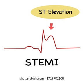 Ecg Steme St Elevation Myocardial Infractiondiagnosis Stock Vector ...