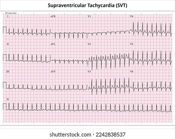 ECG Supraventricular Tachycardia - 12 Leads ECG Paper