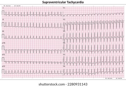 ECG Supraventricular Tachycardia (SVT) - 12 Lead ECG Common Case - 6 Sec lead - Vector Illustration