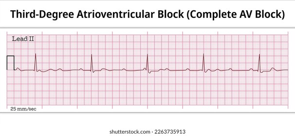 ECG Third Degree Atrioventricular Block - Complete AV Block - 8 Second ECG Paper - Electrocardiography Vector Medical Illustration