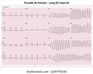 ECG Torsade de Pointes - Long QT Interval - Ventricular Tachycardia - 12 Leads ECG Paper - Vector Medical Illustration