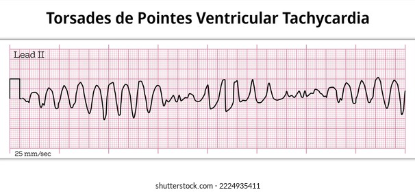 ECG Torsades de Pointes Ventricular Tachycardia - 8 Second ECG Paper 