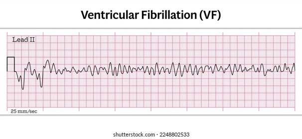 ECG Ventricular Fibrillation (VF) - 8 Second ECG Paper - Vector Medical Illustration