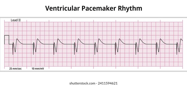 ECG Ventricular Pacemaker Rhythm - Single Chamber - 8 Second ECG Paper - Electrocardiography Vector Medical Illustration