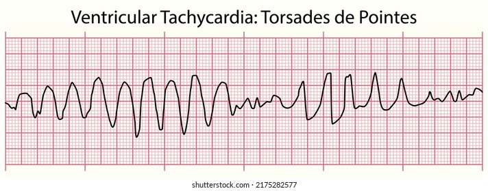 ECG Ventricular Tachycardia Torsades de Pointes Electrocardiogram Case