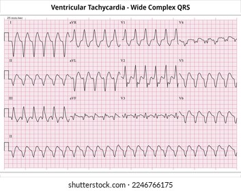 Taquicardia ventricular ECG - Complejo amplio QRS - 12 Leads ECG Paper - Vector - Ilustración médica