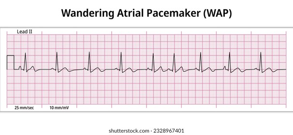 ECG Wandering Atry Pace maker (WAP) - 8. ECG Paper - Electrocardiographische Vektormedizinische Illustration