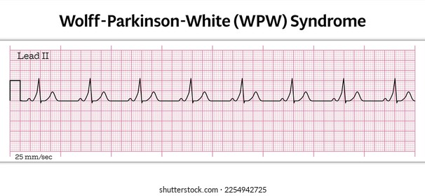 ECG Wolff-Parkinson-White (WPW) Syndrome - 8 Second ECG Paper - Vector Medical Illustration