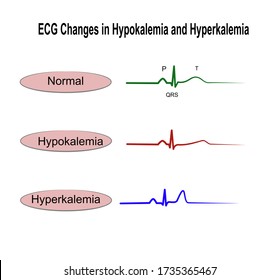 ECG/EKG Changes in Hypokalemia and Hyperkalemia(Potassium imbalance)