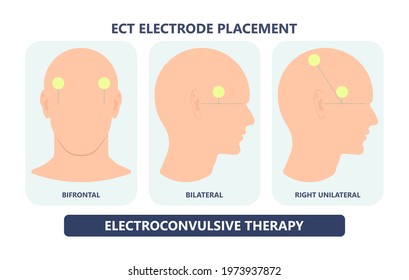 ECT treat MDD Major TMS electric current brain mental health mania bipolar loss Physical head EEG activity signal severe OCD therapist shock deep anxiety Post disease emotional Stigma