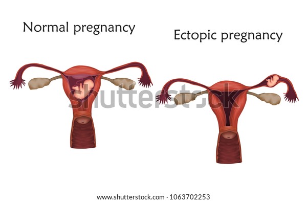 子宮外妊娠と正常妊娠 胎児 子宮 子宮 解剖フラットイラスト 白い背景 のベクター画像素材 ロイヤリティフリー
