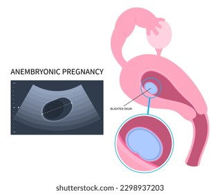 Ectopic pregnancy Blighted ovum of anembryonic loss missed abortion empty egg molar conception fertilization miscarriage and early first Natural