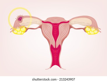 Ectopic Pregnancy Concept. Vector Illustration 