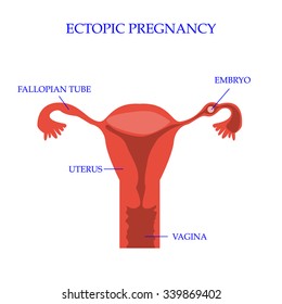 Ectopic Pregnancy Concept. Vector Illustration