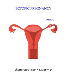 Ectopic Pregnancy Concept. Vector Illustration