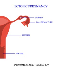 Ectopic Pregnancy Concept. Vector Illustration