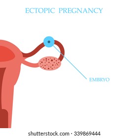 Ectopic Pregnancy Concept. Vector Illustration