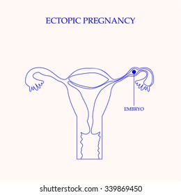 Ectopic Pregnancy Concept. Vector Illustration