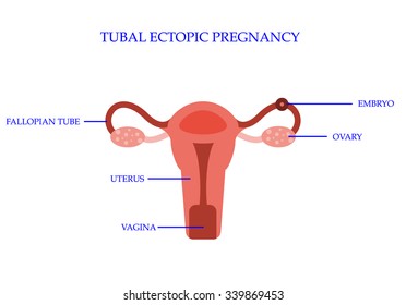 Ectopic Pregnancy Concept. Vector Illustration