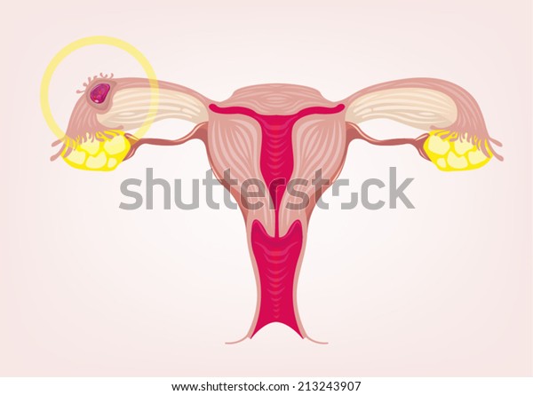 Ectopic Pregnancy\
concept. Vector Illustration\
