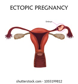 Ectopic pregnancy. Embrio, fetus in fallopian tube, uterus, womb. Anatomy illustration. White background.
