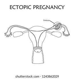 Ectopic pregnancy. Embrio, fetus in fallopian tube, uterus, womb. Anatomy thin line flat illustration. White background.