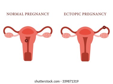 Ectopic Pregnancy And Normal Pregnancy Concept. Vector Illustration