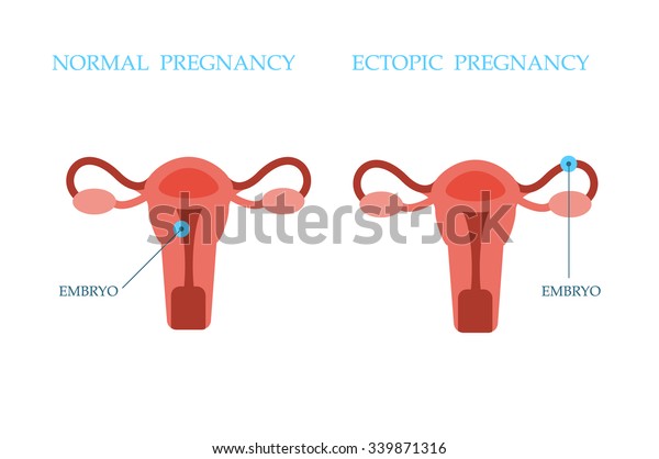 Ectopic Pregnancy and Normal Pregnancy
concept. Vector
Illustration