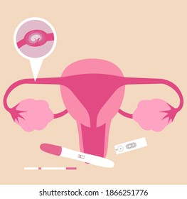 Ectopic Pregnancy Pregnancy Outside Uterus Stock Vector (Royalty Free ...