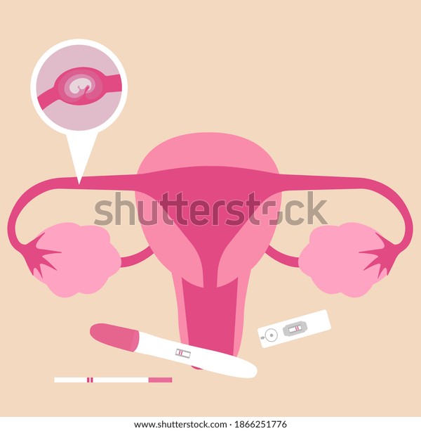 Ectopic Pregnancy Pregnancy Outside Uterus Stock Vector Royalty Free 1866251776 Shutterstock