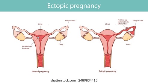 Embarazo ectópico. Problema de embarazo en comparación con el embarazo normal en estilo lineal de dibujos animados.