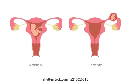 ectopic pregnancy pregnancy problem with comparison with normal pregnancy with modern flat style