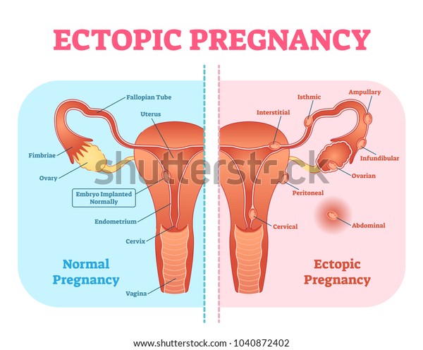 Ectopic Pregnancy or\
Tubal pregnancy medical diagram with female reproductive system and\
various embryo attachment locations. Gynecological pregnancy\
information.