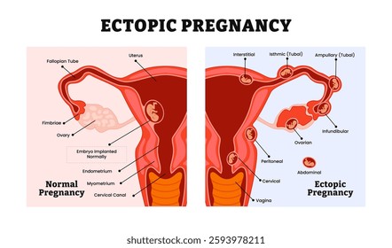 Ectopic Pregnancy or Tubal and Normal pregnancy medical diagram, labeled female reproductive system structure, embryo attachment locations, gynecological medical science educational.