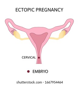 Ectopic Pregnancy. Types of extra-uterine pregnancy is cervical. medical diagram with female reproductive system and various embryo attachment locations. 