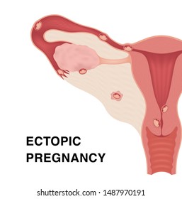 Ectopic pregnancy. Vector realistic medical illustration with inscriptions. Female reproductive organs. Frontal view in a cut.