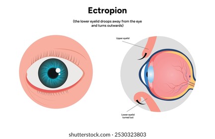 Ectropion eye ophthalmology infographic diagram 