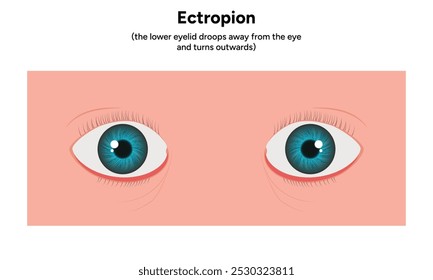 Ectropion eye ophthalmology infographic diagram 