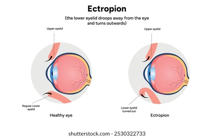 Ectrópio e oftalmologia saudável do olho infográfico 