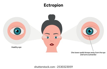 Ectrópio e oftalmologia saudável do olho infográfico 