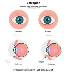 Ectropion and healthy eye ophthalmology infographic 