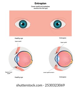 Ectropion and healthy eye ophthalmology infographic 