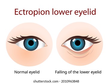 Ectropion Lower eyelid, Ectropion is a condition in which your eyelid turns outward. more common in older