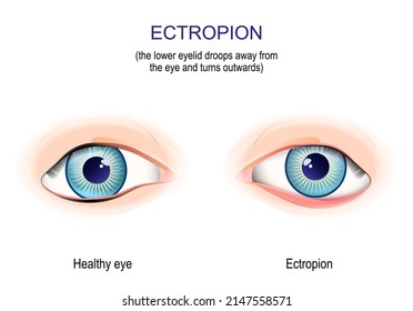 Ectropion. The Lower Eyelid Droops Away From The Eye And Turns Outwards. Medical Exam. Vector Illustration