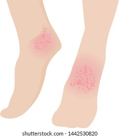 Eczema affected a foot Dermatology skin disease concept vector illustration on a white background isolated