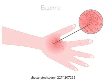 Eczema, dermatitis atópica. Picor, enrojecimiento, erupción en la mano, pies. Diferentes tipos de inflamación de la piel. Enfermedades dermatológicas. Signos de sarna. Lente detallada. Vector de ilustración
